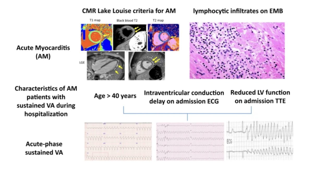 JICE_EP's tweet photo. 🚨Latest #OpenAccess Article in
@JICE_EP 

Clinical Characteristics Associated with Sustained Ventricular Arrhythmia Among Acute Myocarditis Patients: a Multicenter Case-Control Study

🧐📖https://t.co/L4HFBKLOoR

by Moshe Rav-Acha, Daniel Charles Pipilas, @esradgumuser, Arik Wolak, Tomer Ziv-Baran, Yoav Michowitz, Elad Asher, Itshak Amsalem, Tal Hasin, Michael Glikson, Eden Sinai & Chee Yuan Ng

#EPeeps