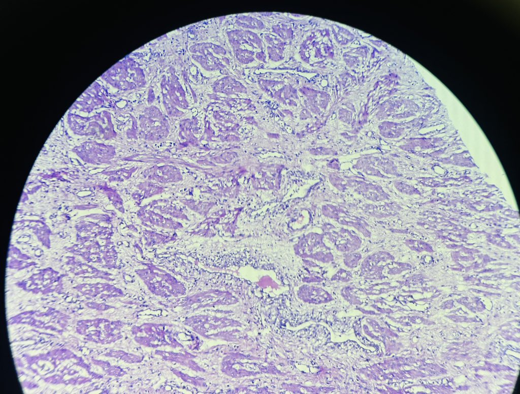 Simrangil128's tweet photo. 20 years female #abdominal mass #ovary #fallopian tube https://t.co/HEF5hmbNyL