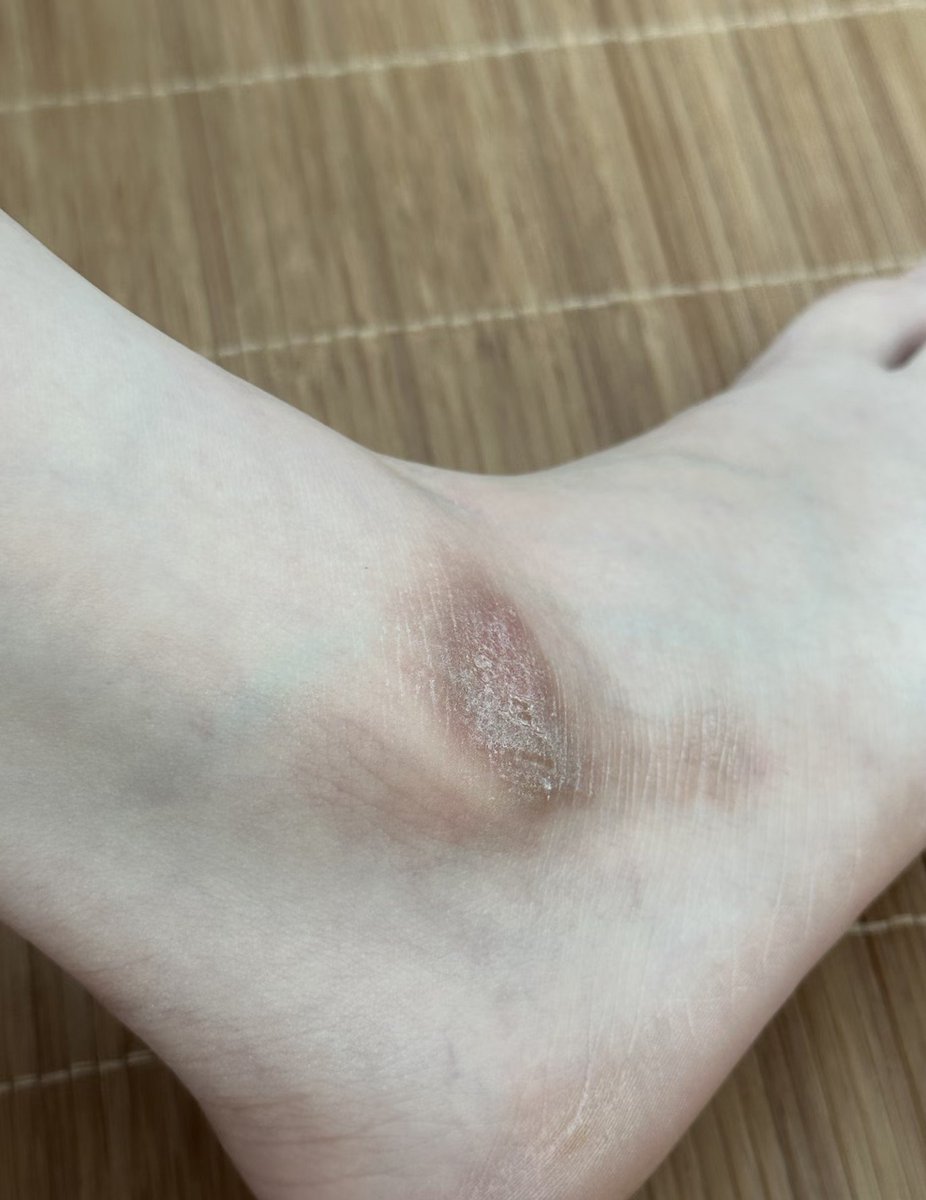 celestwealth's tweet photo. awalnya insecure banget mata kaki aku hitam banget begini 😭
terus konsisten pakai ini baru 2 minggu udah kelihatan banget progresnya 🫶🏻 https://t.co/CfHyMt4NNv
