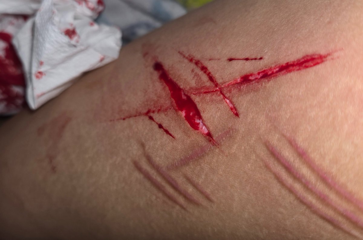 putridd0llz's tweet photo. FAKE/SFX 
pics of sum old cuts that i dida while back. BOTH STYRO
#slittwt #ouchietwt https://t.co/FAqnkp4uJ5