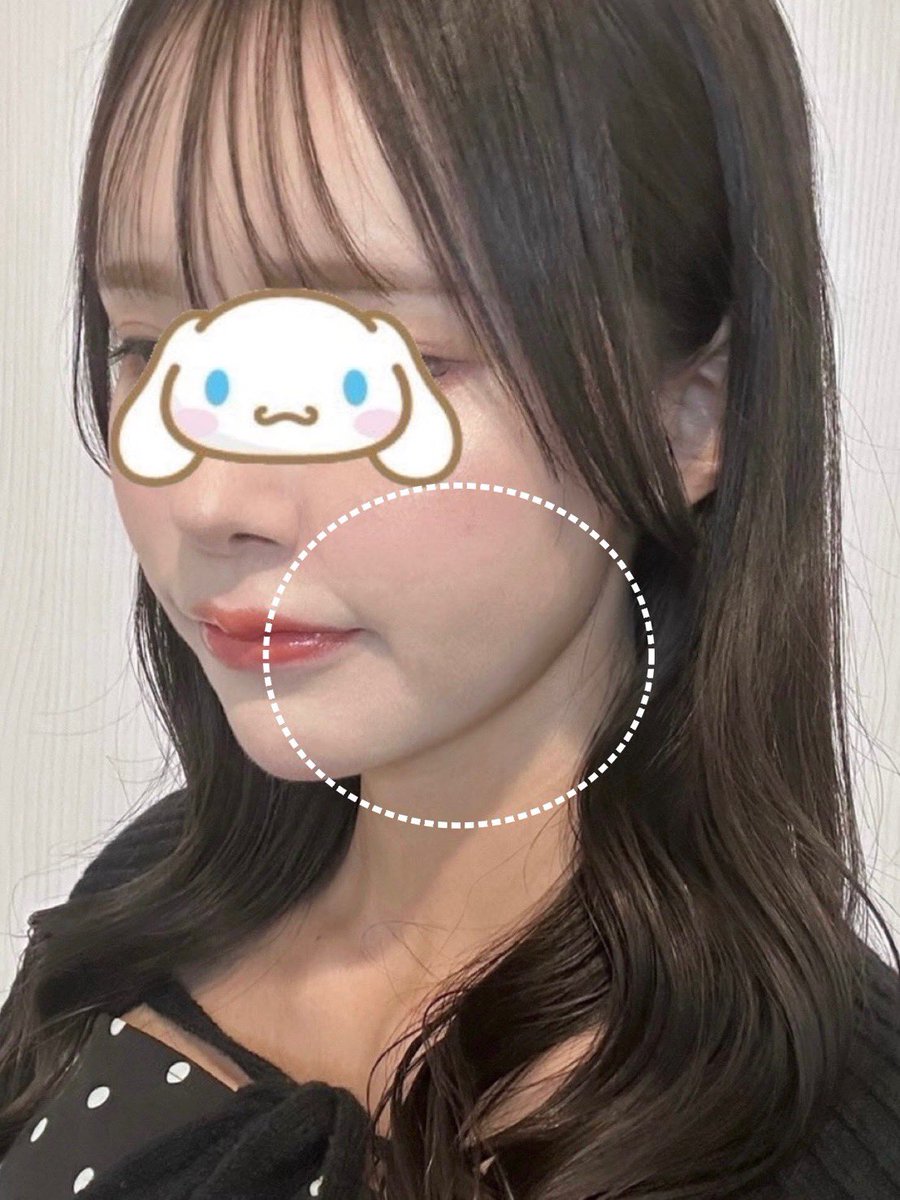 uirin_0201's tweet photo. 口コミで流れてきた症例が綺麗すぎて加工疑ってたレベルなんだけど、やってみたら大成功だった✍🏻🥲

たるみ改善目的だったけど軽く–5歳は若見えする、、口元のもたつきほうれい線も消滅して過去1満足度高い⭐️維持力高いから定期的に受けてる🥲💭（既に2回目） https://t.co/yCaBS0F4Vf