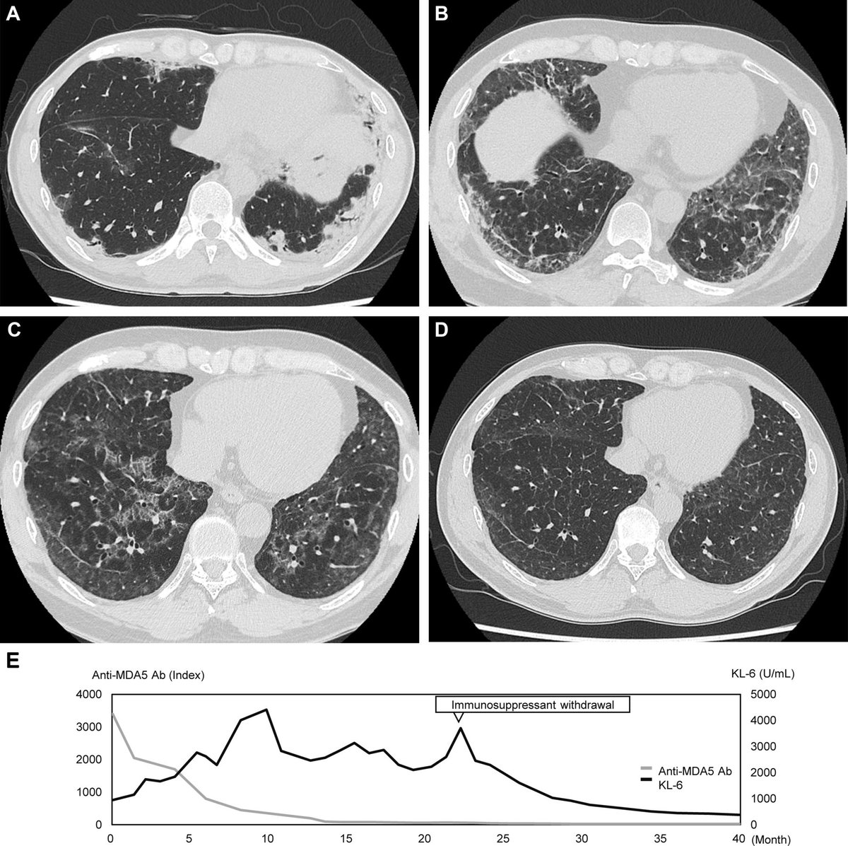 ThoraxBMJ's tweet photo. Secondary pulmonary alveolar proteinosis mimicking ILD progression in anti-MDA5 dermatomyositis https://t.co/MfHfce32ad https://t.co/ePCZwKqZGQ