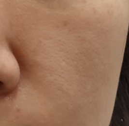 tlsxkrdk's tweet photo. ウォニョン様の肌の秘訣がクリニックで受けてるLDMらしいから男の俺が使ったら1ヶ月でこの効果で怖すぎた https://t.co/Io3M1gPgRn