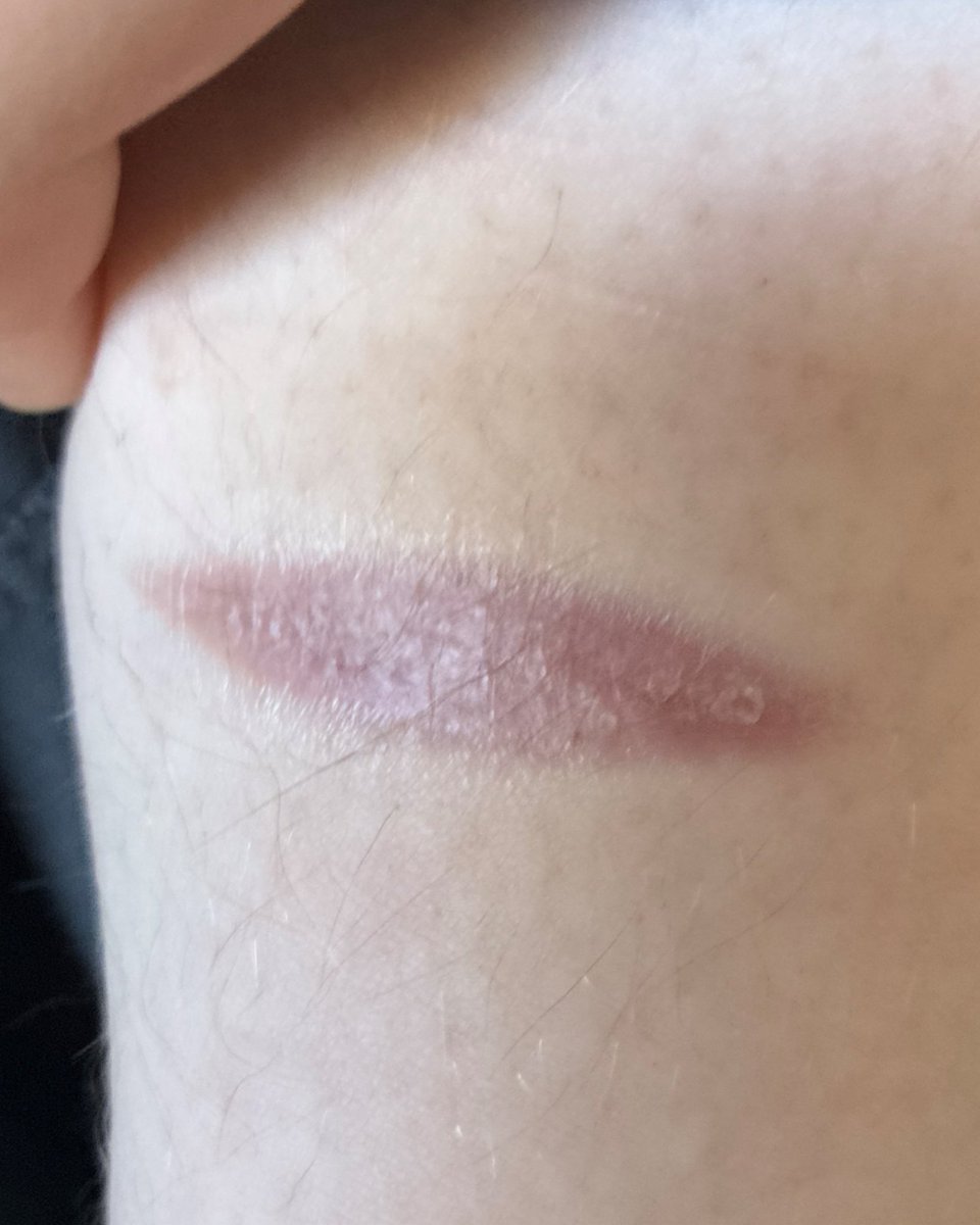 lovetheguts's tweet photo. fresh vs scar ☹️pls dont be stupid like me and dont do it on your ankle............
ALL FAKE, AI SFX MAKEUP!!

🏷️ #slittwt #shtwt #ouchietwt #beanstwt https://t.co/RKaAzsAw4s