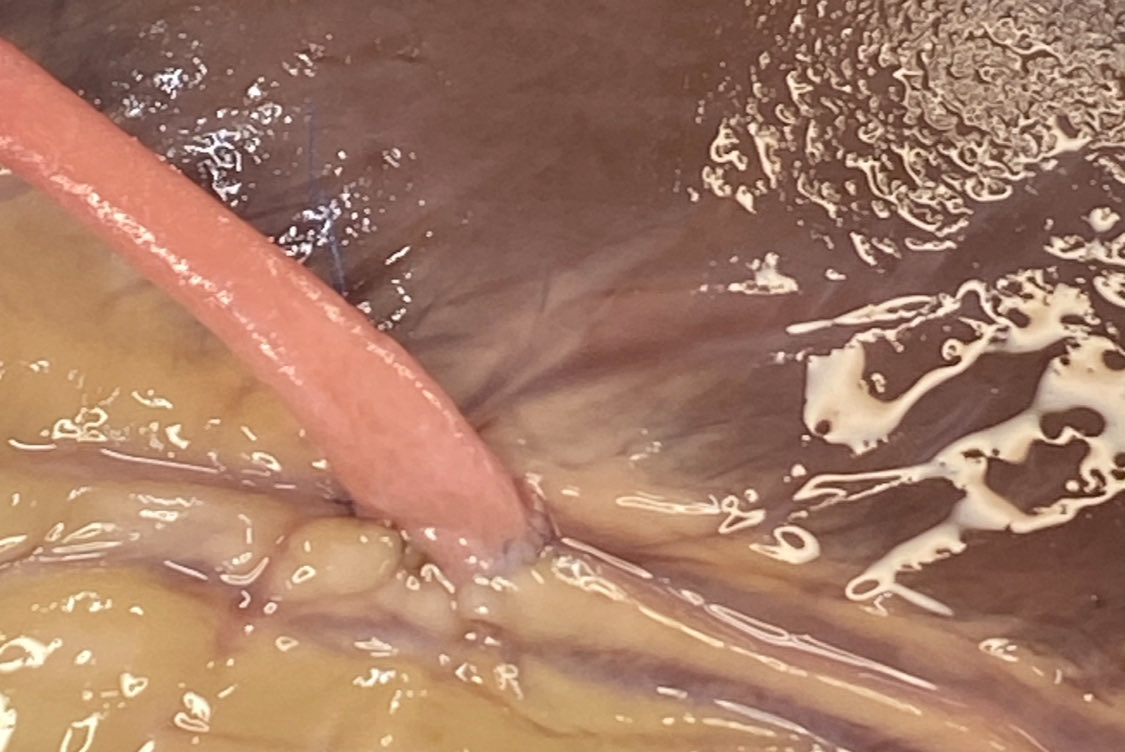 taito_877's tweet photo. Coronary anastomosis 

←While in med school                     PGY1→ https://t.co/MCS9fWiJhh