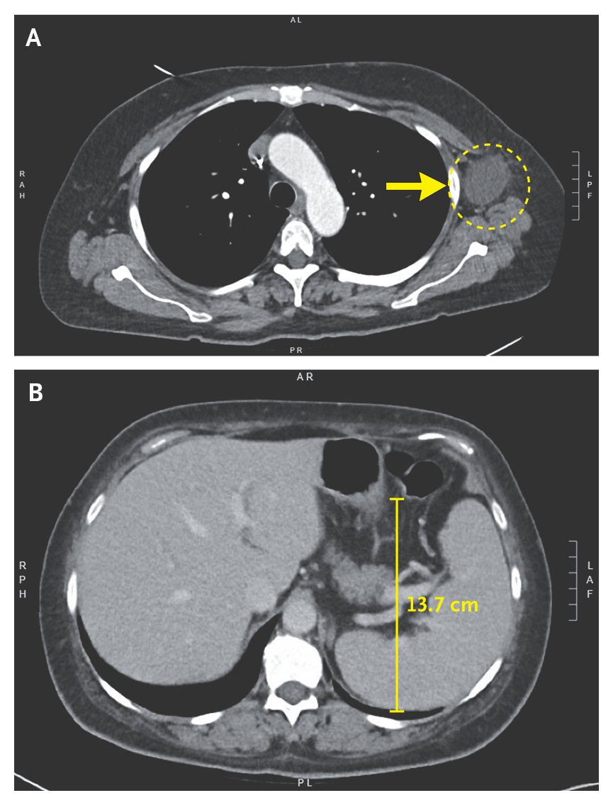 NEJM's tweet photo. 𝗖𝗹𝗶𝗻𝗶𝗰𝗮𝗹 𝗣𝗿𝗼𝗯𝗹𝗲𝗺-𝗦𝗼𝗹𝘃𝗶𝗻𝗴: 𝗖𝗼𝗻𝘀𝘂𝗺𝗲𝗱 𝘄𝗶𝘁𝗵 𝗜𝗻𝗳𝗹𝗮𝗺𝗺𝗮𝘁𝗶𝗼𝗻 

A 60-year-old woman with stage II triple-negative breast cancer presented to the emergency department with a weeklong history of fevers, rigors, malaise, nonproductive cough, and nausea. She reported intermittent lightheadedness, headaches, and neck pain when febrile but no sore throat, rhinorrhea, shortness of breath, vomiting, abdominal pain, or dysuria. She noted no recent travel or sick contacts. Two months before presentation, she completed neoadjuvant carboplatin, paclitaxel, and doxorubicin and then, 1 month before presentation, underwent lumpectomy of the left breast and sentinel-lymph-node biopsy. She had also been treated as part of a clinical trial with multiple cycles of pembrolizumab (first dose, 6 months before presentation; last dose, 6 days before presentation). Although she had had transient neutropenia from chemotherapy, her white-cell counts had normalized after her last cycle. Postoperatively, mild tenderness and swelling around her left axilla had developed without systemic signs of infection; computed tomographic (CT) imaging was consistent with an uncomplicated seroma. In the days leading up to this presentation, her tenderness in this area had resolved. 

CT of the chest, abdomen, and pelvis with intravenous contrast was performed and revealed a persistent fluid collection in the left axillary space (seen in Panel A) where the patient had undergone her lumpectomy and axillary lymph-node biopsy. Although it was slightly larger than on previous imaging, there were no features to suggest a superimposed abscess. There was also mild splenomegaly (seen in Panel B) but no other evidence of any inflammatory or infectious process. 

Read the full case details and authors’ commentary in the Clinical Problem-Solving article “Consumed with Inflammation” by H.L. Cho et al.: https://t.co/6IcM7T7Kar  

NEJM subscribers: Try asking AI Companion to break this article down into teaching points for you.