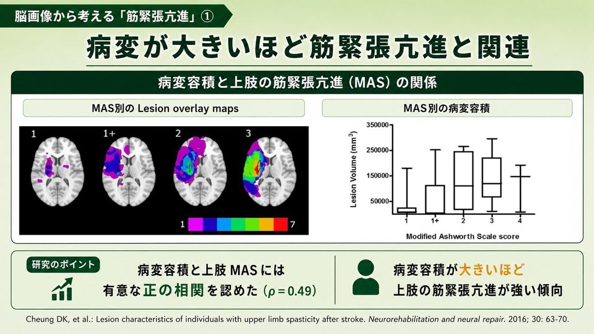 y_sawajima's tweet photo. 🧠 脳画像から考える「筋緊張亢進」①
装具選択や痙縮治療を考えるとき、脳画像も一つの手がかりになります。研究では、病変が大きいほど、上肢の筋緊張亢進（MAS）が強い傾向が示されました。今回は「病変の大きさ」という視点から。ほかの要因も順に見ていきます。
参考▶︎https://t.co/mcvZhKly4z https://t.co/qtslsQOi0M
