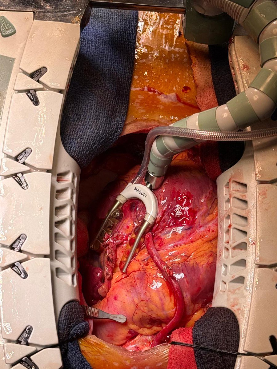 Shahzad77891064's tweet photo. Pro tip: Need more length for RIMA to OM?
Use the transverse sinus.
It’s the highway behind the aorta — keeps the graft protected and perfectly aligned. #CABG #BIMA https://t.co/vXbQB8jCZA
