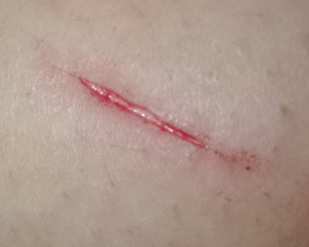 LynnIxxII's tweet photo. Worse? At that moment I didn't have anything for aftercare other than a tissue and a tiny band https://t.co/j9XaDL3QnK