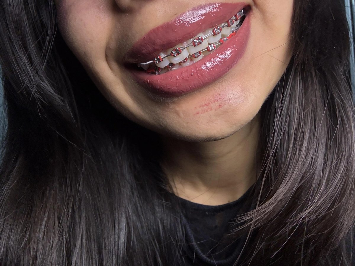 GoGoGoonAddict's tweet photo. You're on the right track to being a good pervert if you can never stop jizz on braces... again and again and again. https://t.co/X1xc1EIeW7