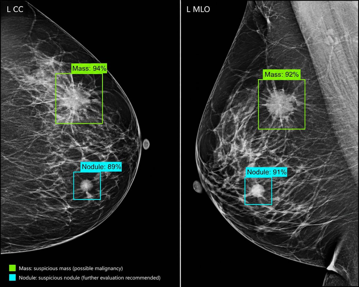 scanwithagera's tweet photo. 🩷 Breast Cancer

Breast cancer is the most commonly diagnosed cancer among women worldwide. Early detection can make a life-changing difference.

Agera AI helps highlight suspicious masses and nodules on mammograms, providing radiologists with an additional layer of analysis.

AI is designed to support medical professionals, not replace their expertise or clinical judgment.