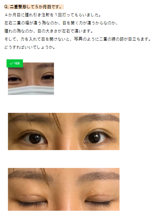 pointpsjp's tweet photo. [目整形質問コーナー]

🙋‍♀️Q.二重整形��て５ヶ月目ですが、
左右差と二重の食い込みが
強いのが気になります。

📌二重修正専門、韓国ポイント整形外科の
パク院長からわかりやすくご説明致します。

📩公式LINE︙日本語でOK
https://t.co/dxY8upynaJ

#二重整形 #二重DT #食い込み ＃目フル https://t.co/IYKYmjZrsI
