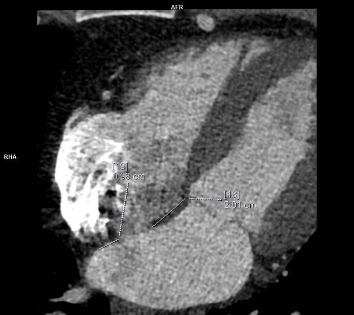 smexcardiologia's tweet photo. 🫀#CardioClave
¿Qué medir?
• Diámetros y longitud de la coartación
• Relación istmo/aorta diafragmática
• Diámetros y bordes de la comunicación interauricular
• Drenaje venoso pulmonar
Contenido elaborado por:
Dra. M. Fernanda León Blanchet @dra.mfernandablanchet
Dra. Liliana Zarco García @lilin4l
Dra. Cecilia Matheus @cecimatheus
#CardioClave #Cardiología #ImagenCardiovascular #CardiopatíasCongénitas