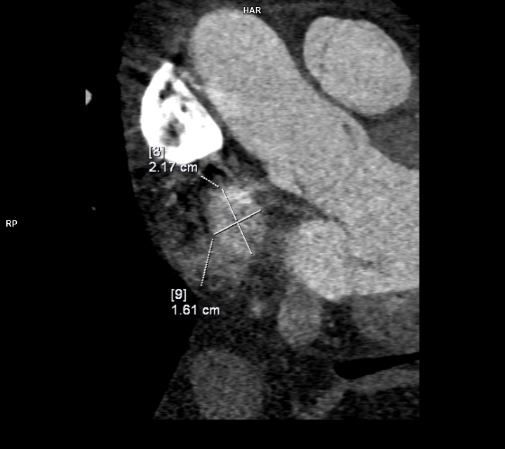 smexcardiologia's tweet photo. 🫀#CardioClave
¿Qué medir?
• Diámetros y longitud de la coartación
• Relación istmo/aorta diafragmática
• Diámetros y bordes de la comunicación interauricular
• Drenaje venoso pulmonar
Contenido elaborado por:
Dra. M. Fernanda León Blanchet @dra.mfernandablanchet
Dra. Liliana Zarco García @lilin4l
Dra. Cecilia Matheus @cecimatheus
#CardioClave #Cardiología #ImagenCardiovascular #CardiopatíasCongénitas