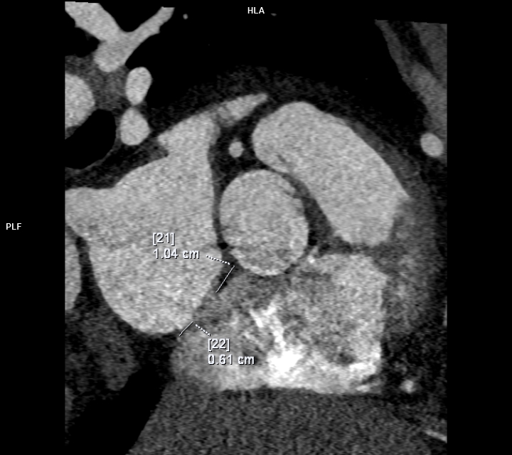 smexcardiologia's tweet photo. 🫀#CardioClave
¿Qué medir?
• Diámetros y longitud de la coartación
• Relación istmo/aorta diafragmática
• Diámetros y bordes de la comunicación interauricular
• Drenaje venoso pulmonar
Contenido elaborado por:
Dra. M. Fernanda León Blanchet @dra.mfernandablanchet
Dra. Liliana Zarco García @lilin4l
Dra. Cecilia Matheus @cecimatheus
#CardioClave #Cardiología #ImagenCardiovascular #CardiopatíasCongénitas