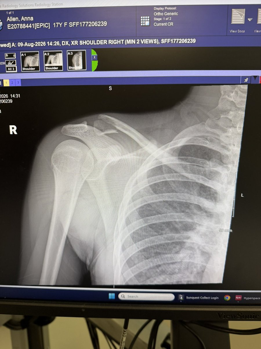 AnnaAllen03's tweet photo. It’s all about the comeback not the setback❤️‍🩹 Broke my collarbone and going through another surgery tomorrow…. But always trusting Gods Plan! https://t.co/cFFIF0sIrU