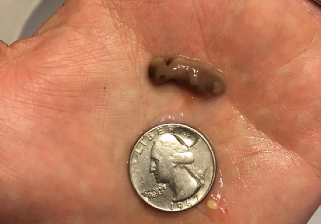 LiveAction's tweet photo. Baby Reuben was miscarried at 5 weeks.

He already had his head, his eyes, arms, and legs growing.

His father said, “This isn’t tissue. It’s a life created in God’s image with a heart and an eternal living soul.”

Babies Reuben’s age are a primary target for the abortion pill.

It’s time to BAN this deadly drug.
