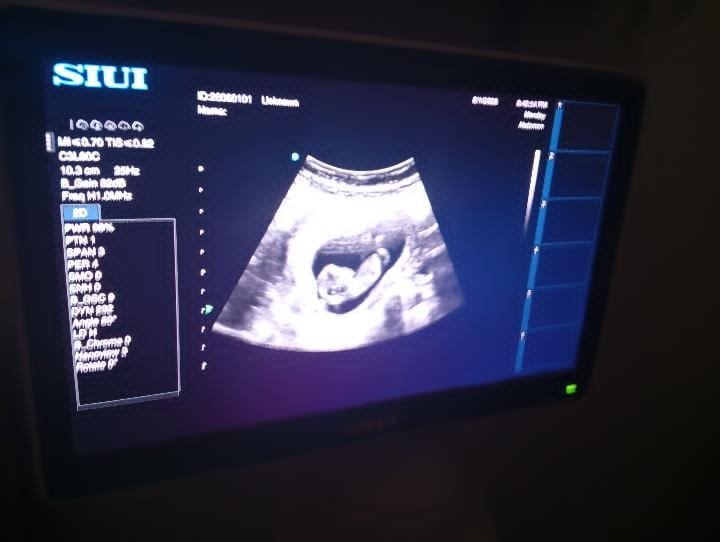 HaithamElmasri1's tweet photo. Today, my wife has completed her fifth month of pregnancy and has now entered the first days of her sixth month. In the midst of these harsh circumstances we are living through, I try every day, with everything I can, to secure her basic needs so that she can maintain her health and our baby can come into this world safe and healthy.

But today, I have reached a point of helplessness. I am no longer able to provide her with her most basic needs: food, clean drinking water, proteins, vitamins, and supplements that she desperately needs at this sensitive stage of pregnancy.

Therefore, I urgently need you now. I hope you can help us so that we can provide my wife with her essential needs, allowing her to continue her pregnancy safely, for everything to go well, and for our baby to come to us healthy.

Every donation, no matter how small, will help us greatly in providing what my wife needs, and will contribute to giving our baby a chance to come into this world healthy and free from illness and malnutrition.

Please, donate and share the campaign.
https://t.co/7l0S5qUgSJ