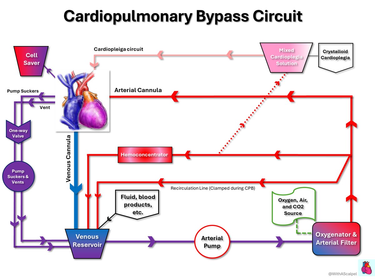 WithAScalpel's tweet photo. Cardiopulmonary Bypass Circuit🤖🫀🫁

👉Venous blood drains into the reservoir, then passes through the pump, oxygenator, and arterial filter before returning to the aorta.
👉The oxygenator provides gas exchange while the arterial filter helps remove microbubbles, making this segment central to gaseous microemboli control during CPB.