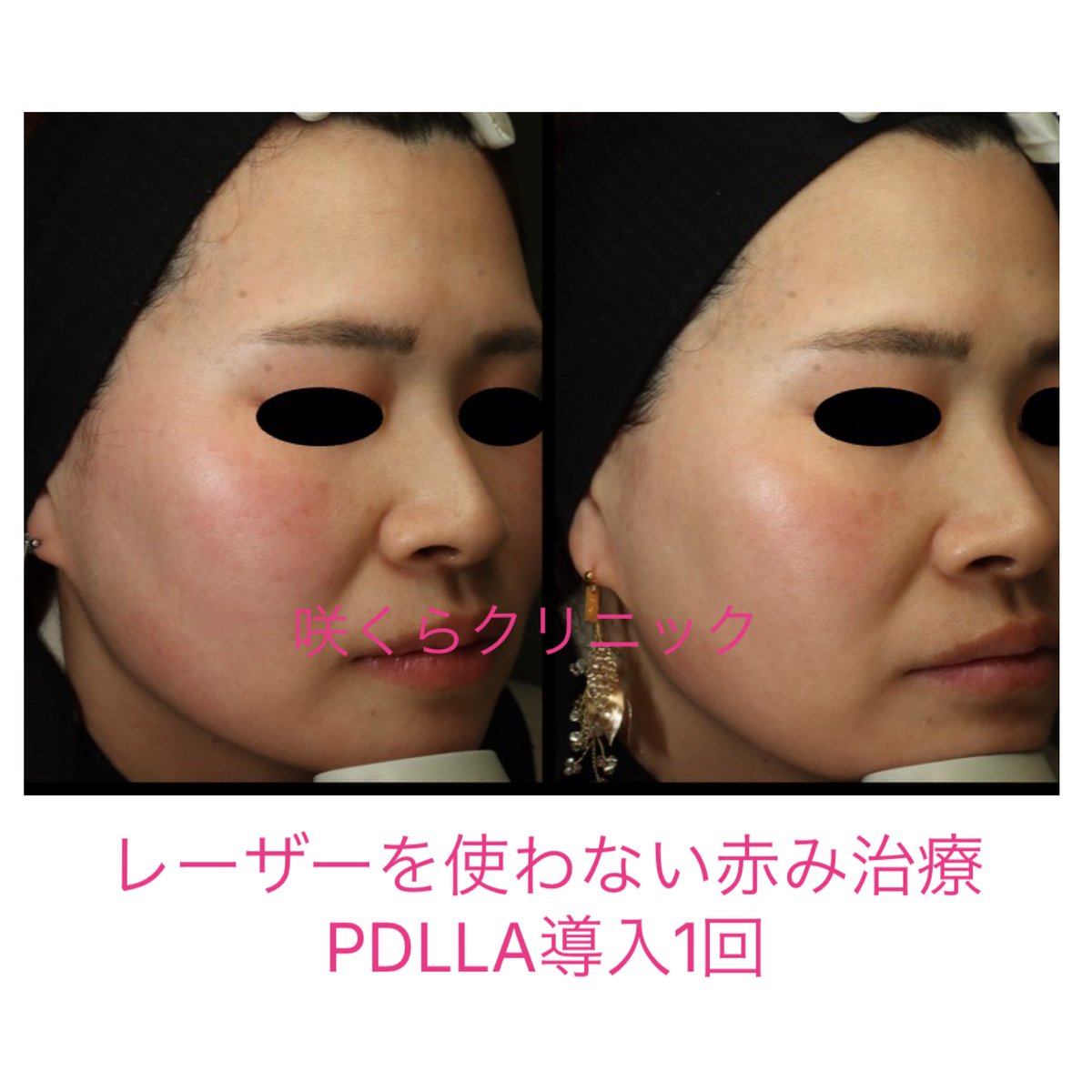 Anjosakuracl's tweet photo. レーザーを使わない酒さ赤み治療。
写真はPDLLA導入1回。
レーザーと異なり、効き出すと数ヶ月以上効きます。すなわち1回の処置でも数ヶ月以上効果が持続することあり。
副作用　軽度の痛み、軽度の出血、軽度の腫れなど。　

こちらは自由診療です。
※副作用についてよく理解してから行ってください。