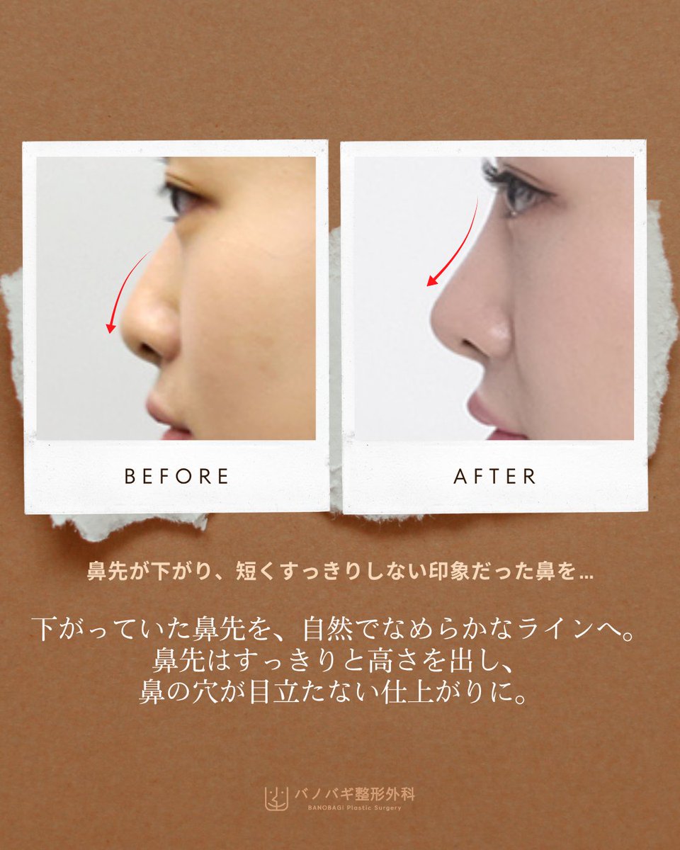 banobagijapan's tweet photo. 鼻先のバランスを整えることで、
横顔もすっきりとした印象へ  

高さとやわらかなラインを意識し、自然で美しい鼻のラインをご提案します。

#鼻 
#鼻整形
#鼻先縮小 
#鼻尖形成 https://t.co/Mk4tEASK0V