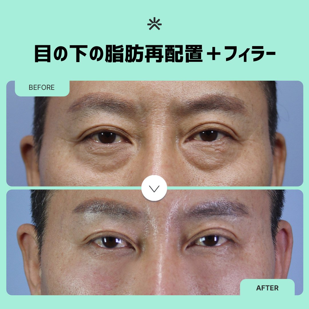 KBGGORG's tweet photo. KLEAMクリニック 症例写真
目元の印象をすっきり整えたい方に
目の下の脂肪再配置+フィラーで
目の下の凹凸を整え、自然な印象へ✨
さらに、気になる目元のシワもケア💗
症例写真をぜひチェック!
#KLEAM #目の下脂肪再配置 #目の下フィラー #目元のシワ #目元ケア #症例写真 #韓国美容 https://t.co/x49cdDoatq