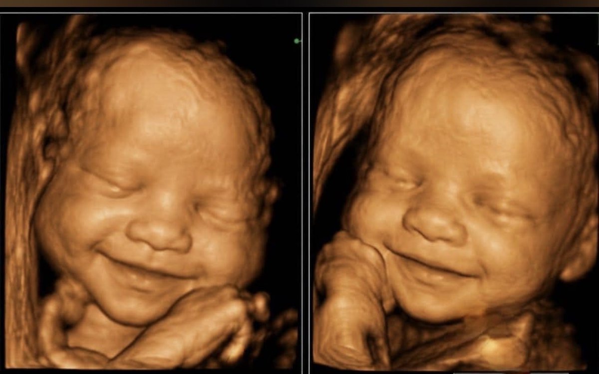 JayUgooo's tweet photo. A beautiful smile captured on 3/4D Ultrasound.😊
This is so cute,,, Happy Boy🥰
#Radiographers #Ultrasound #Sonographer
☢️☢️☢️☢️☢️☢️☢️☢️ https://t.co/wFLZeCLq3v
