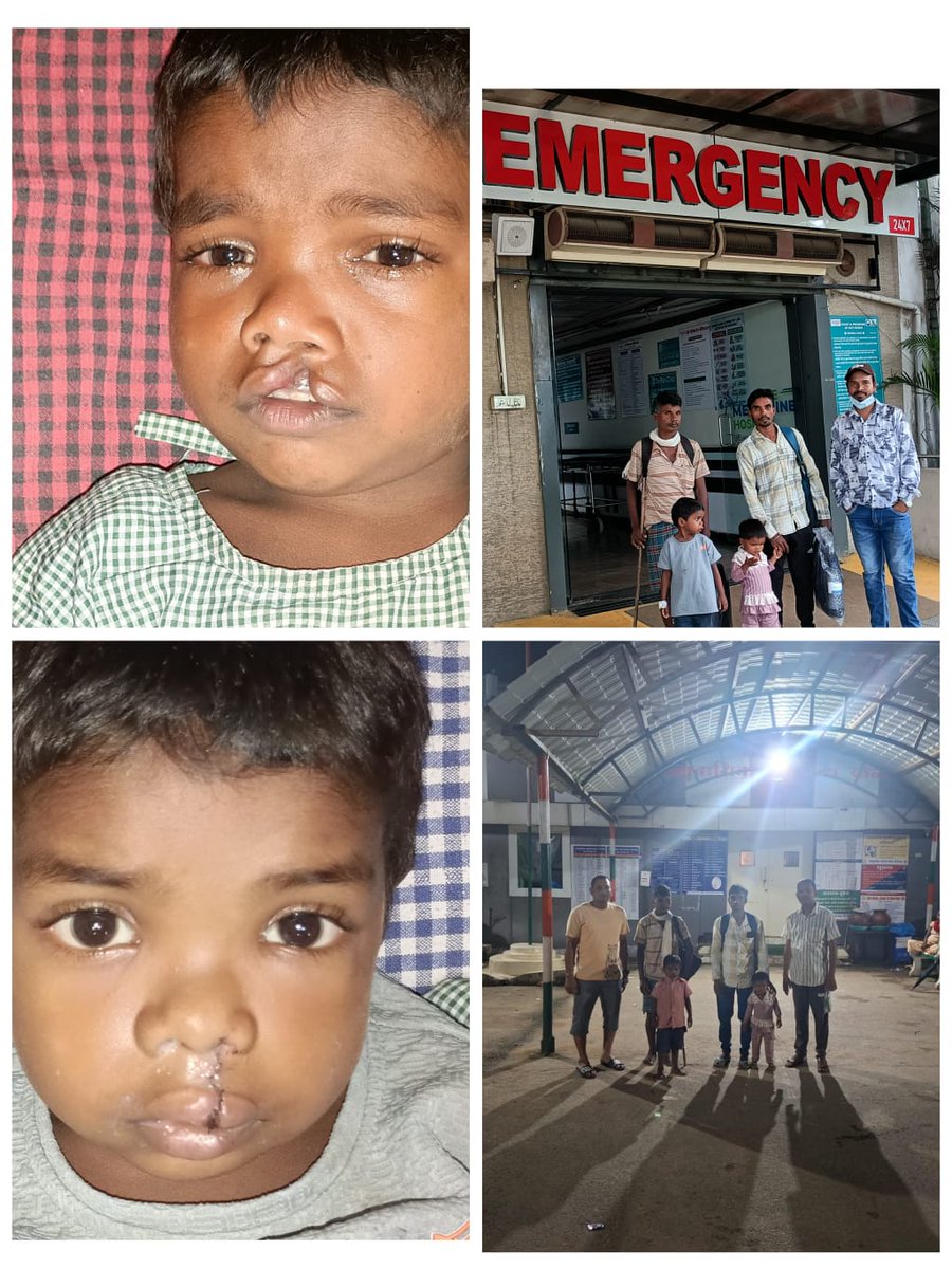 BijapurHealth's tweet photo. By RBSK team Block Bhairamgarh Dist Bijapur 
Disease - cleft lip
Successfully surgery at Shree Medishine Hospital Raipur.
@DistrictBijapur @MoHFW_INDIA @HealthCgGov @DPRChhattisgarh https://t.co/ANC1YnETwu