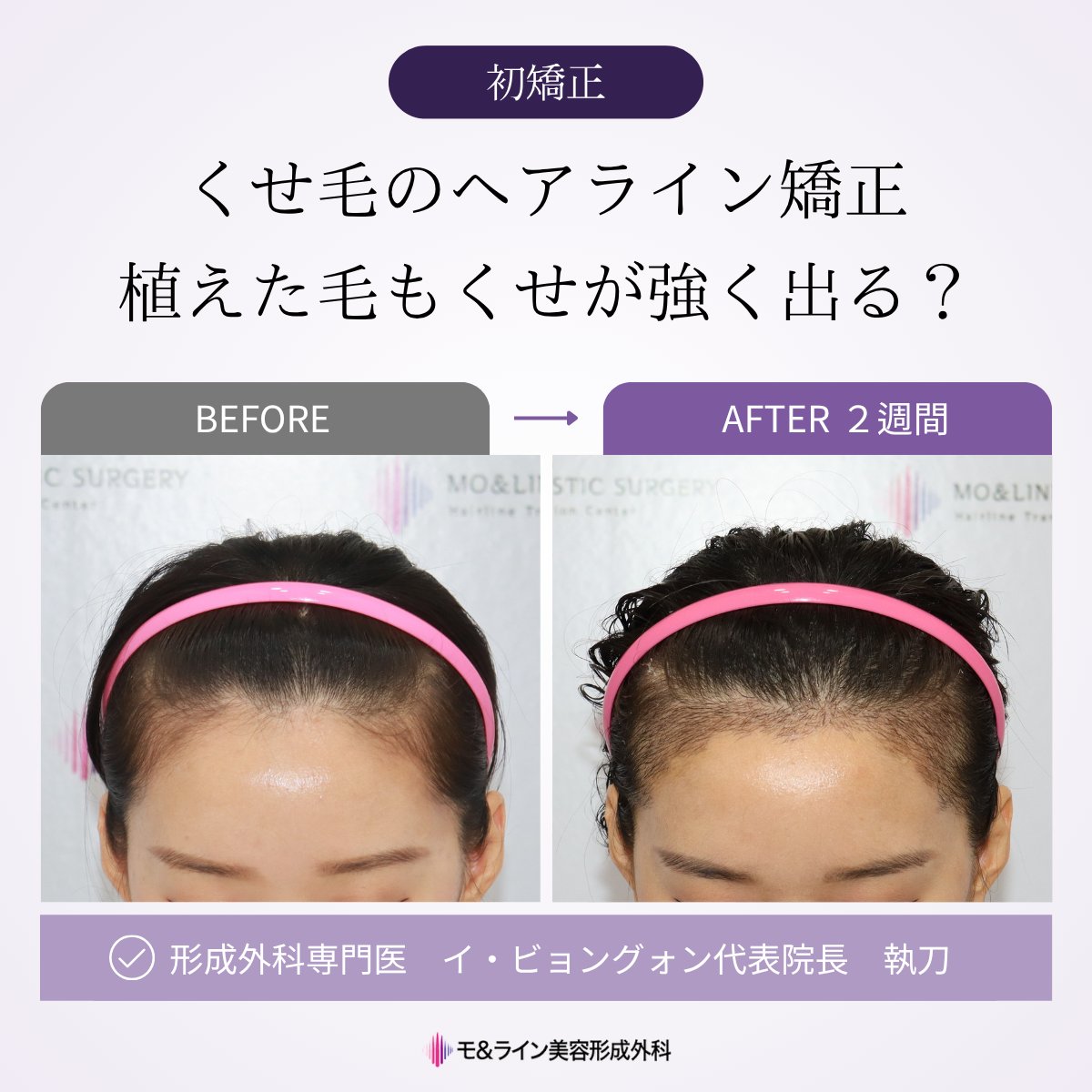 moandlineps_jp's tweet photo. 🔖植毛手術レポ
くせ毛でも自然なヘアラインへ✨

今回の患者様が特に気にされていたのは、「くせ毛でも自然に仕上がる？」ということでした。

実は、自然なヘアラインをつくるには、植えるの「量」だけでなく、太さ・向き・クセ・カールまで見極めることが重要です🌱

🥼イ・ビョングォン代表院長 執刀
→経歴17年以上の形成外科専門医× 手作業による精密ラインスリット

📩 お問い合わせ：https://t.co/Er5o5tm5mL

#モアンドライン #moandline #韓国植毛手術
@moandlineps_jp