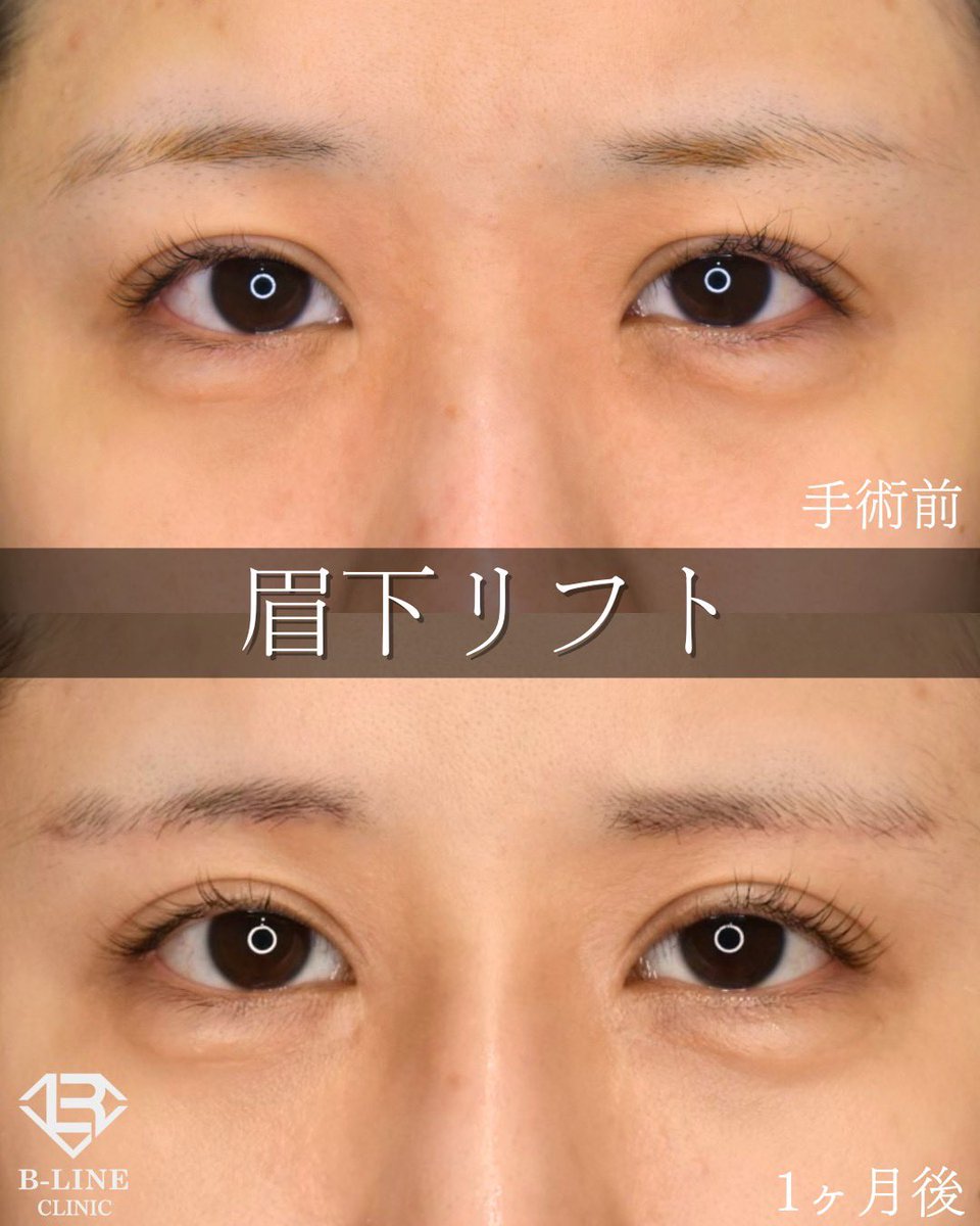 dr_koikeyasu's tweet photo. 【眉下リフト】　【眉下切開】　
1ヶ月後 ⭐️モニター価格15万円〜⭐️

上瞼のたるみが無くなり、パッチリした二重になりました。
まだ1ヶ月後ですが、傷跡は眉毛に隠れるように切開しているため目立ちません✨
眉下切開は二重切開と比べると、格段に腫れは少なくできます！
腫れ、傷跡が目立ないようにするには、術者の技術力次第ですので、経験豊富な美容外科専門医にお任せ下さい😌

☑️まぶたの厚みが気になる方
☑️目と眉の距離を短くしたい方
☑️目の開きを良くしたい方
には眉下リフトがおすすめです。
目と眉の距離が短くなることで、欧米人のような大人っぽい目元になります⭐️