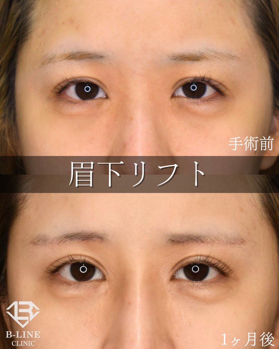 dr_koikeyasu's tweet photo. 【眉下リフト】　【眉下切開】　
1ヶ月後 ⭐️モニター価格15万円〜⭐️

上瞼のたるみが無くなり、パッチリした二重になりました。
まだ1ヶ月後ですが、傷跡は眉毛に隠れるように切開しているため目立ちません✨
眉下切開は二重切開と比べると、格段に腫れは少なくできます！
腫れ、傷跡が目立ないようにするには、術者の技術力次第ですので、経験豊富な美容外科専門医にお任せ下さい😌

☑️まぶたの厚みが気になる方
☑️目と眉の距離を短くしたい方
☑️目の開きを良くしたい方
には眉下リフトがおすすめです。
目と眉の距離が短くなることで、欧米人のような大人っぽい目元になります⭐️