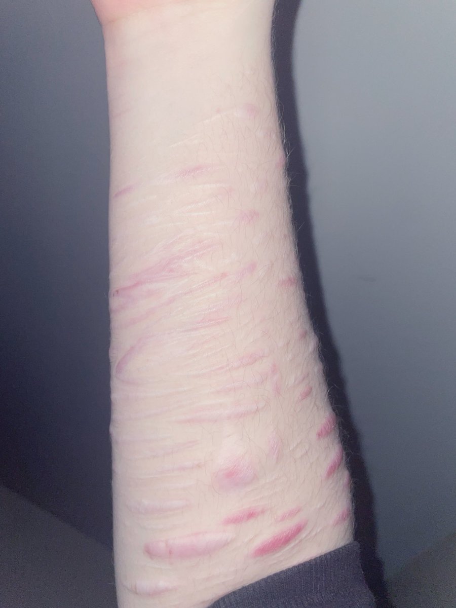 LexaproLovebug's tweet photo. yeah its over. im stuck in this flesh forever. nobody could ever love something like this. nobody could ever understand 

and these are just my forearms. like fuck https://t.co/giTq1Z7nRt