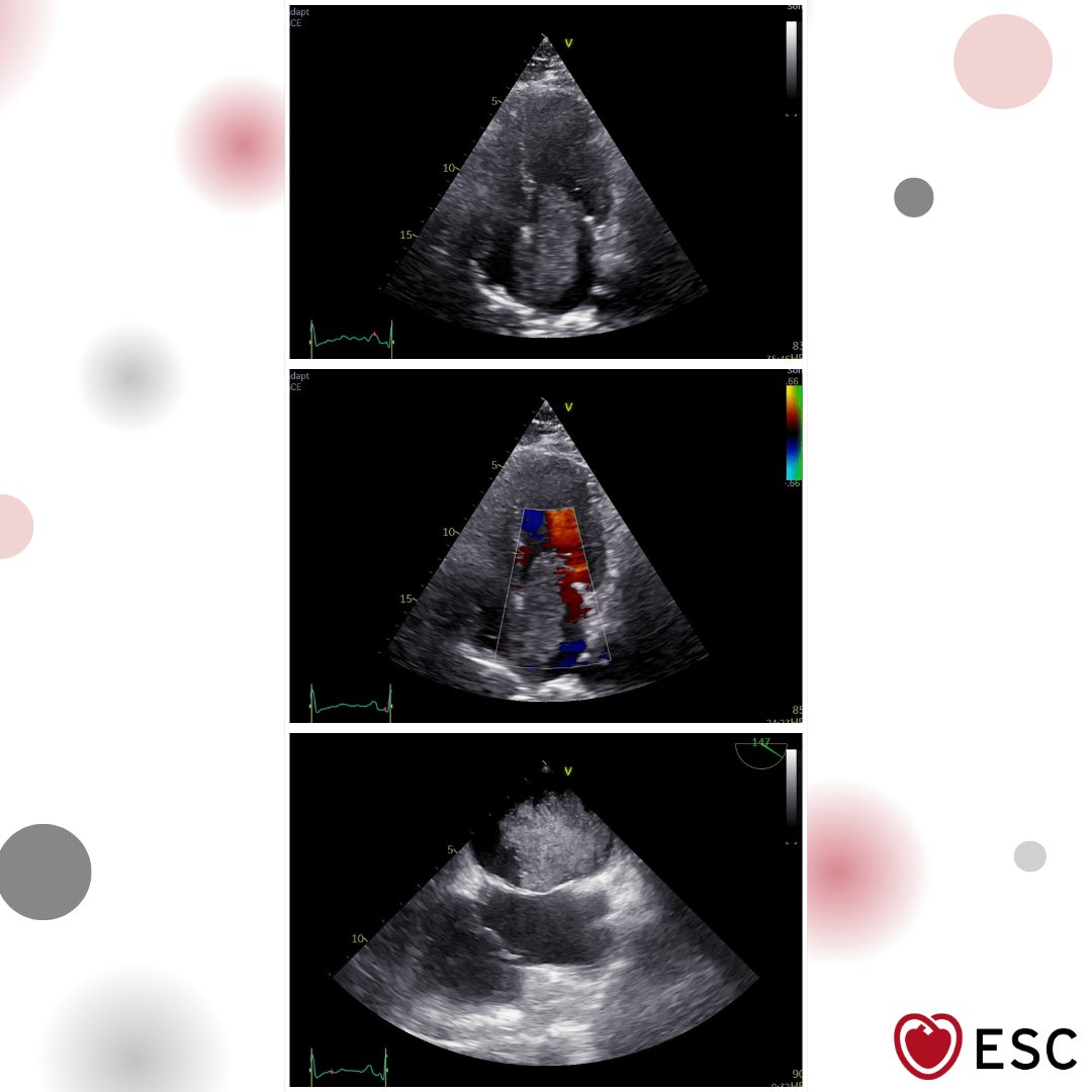escardio's tweet photo. #ImageOfTheWeek by Bojana Saroskovic and Maja Stefanovic from the Institute for Cardiovascular Diseases of Vojvodina, Serbia.

What do the echocardiographic images demonstrate in a 48-year-old woman presenting with dyspnea? https://t.co/liPLtixOeg https://t.co/BWnMbyw18I