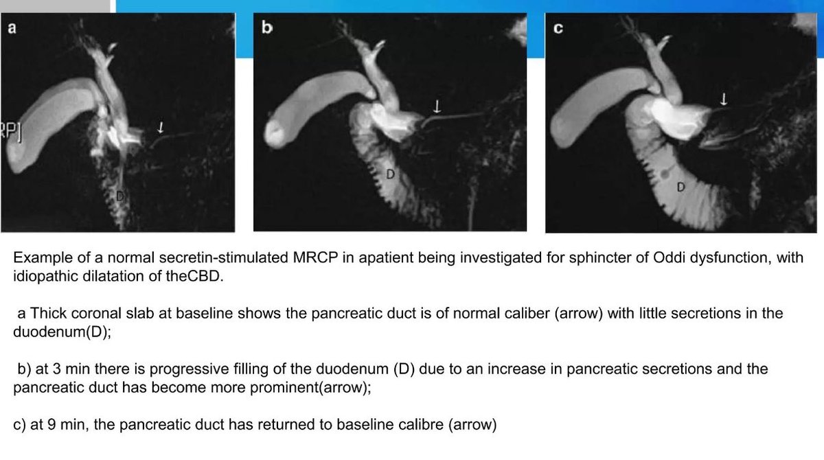 theajaydevb's tweet photo. Secretin-enhanced MRCP (S-MRCP) 

Secretin stimulates pancreatic ductal secretion, increasing fluid within the pancreatic duct and duodenum—making subtle ductal abnormalities easier to detect.

🔹 Useful in chronic pancreatitis
🔹 Pancreas divisum
🔹 IPMN & duct–cyst communication
🔹 Recurrent acute pancreatitis
🔹 Can provide functional assessment of exocrine secretion

In short: Secretin makes the pancreatic duct “speak louder” on MRCP. 

#Gastroenterology #Medtwitter