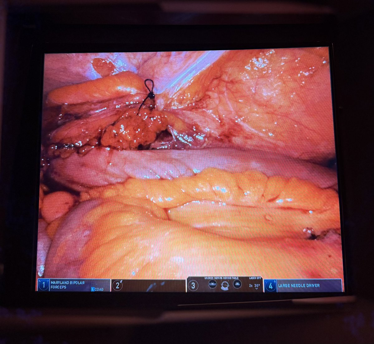 yang_kunlin's tweet photo. Key takeaways for the 5-port technique of right sided robotic ileal ureter

📍 Key steps: ileocecal mobilization + bladder Psoas Hitch + using the shortest ileum
📍 Always isoperistaltic, never antiperistaltic, for partial or total replacement 

#Surgery #SurgicalTips #MedEd https://t.co/X1tNVsZ43r