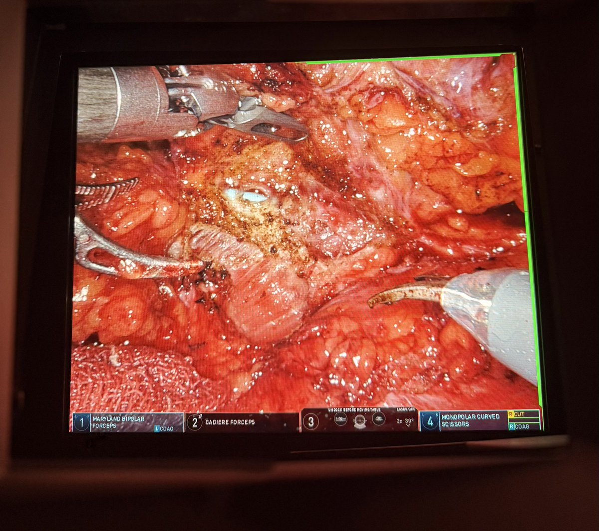 yang_kunlin's tweet photo. Key takeaways for the 5-port technique of right sided robotic ileal ureter

📍 Key steps: ileocecal mobilization + bladder Psoas Hitch + using the shortest ileum
📍 Always isoperistaltic, never antiperistaltic, for partial or total replacement 

#Surgery #SurgicalTips #MedEd https://t.co/X1tNVsZ43r