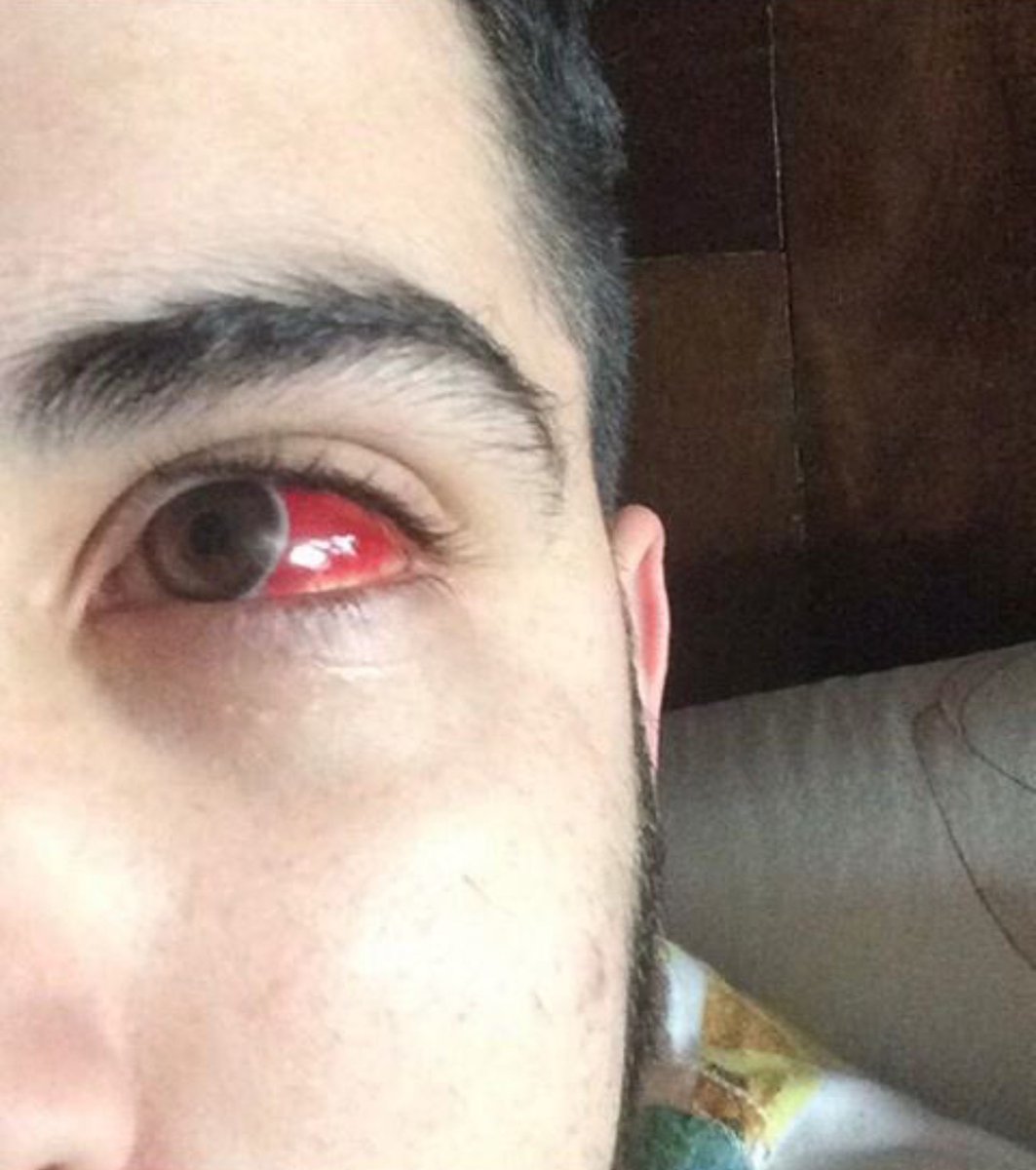 Burrogan's tweet photo. Así ha quedado mi ojo después del día de ayer.

Imprudencia total por mi parte el haber desobedecido todas las precauciones y recomendaciones que se debían haber tomado.

Por suerte ha quedado todo en un susto, pero he aprendido la lección.

No volveré a ver un partido del VCF. https://t.co/kq3Fhrp3B8