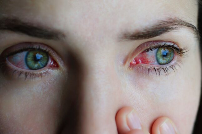 ShadesFrance's tweet photo. 🚨☀️ Après l'éclipse d'hier soir, plusieurs recherches Google liées aux douleurs oculaires ont CONSIDÉRABLEMENT AUGMENTÉES 👁️‍🗨️

"mal aux yeux", "tache yeux", "douleurs yeux"

👉 Pourtant, les symptômes de rétinopathie solaire n'apparaissent JAMAIS immédiatement, ils surviennent dans les heures voire les jours suivants