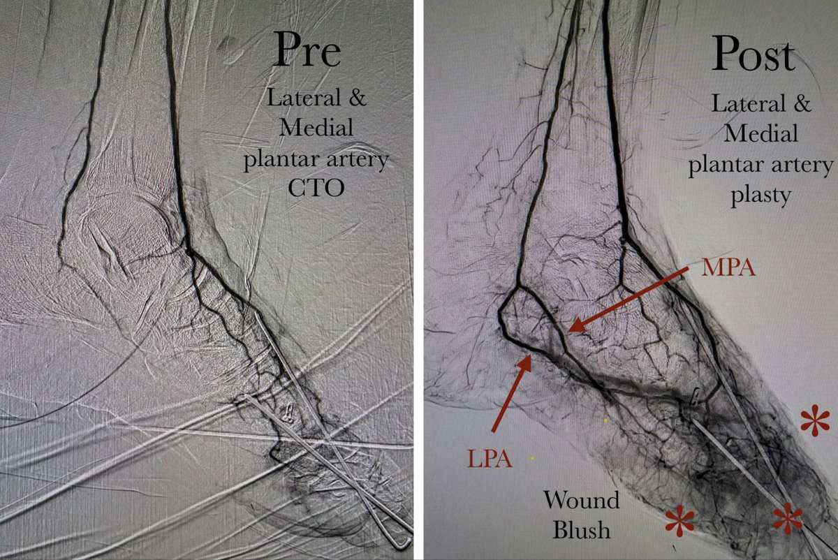 karananandpara's tweet photo. Case 162: with @BhaveshPopat7 @DrAntariksh @shubhamvanshi07 @DrVaibhavThakur
.
Revascularizing both Below the Ankle (BTA) Pedal Vascular Loops
.
YouTube Link: https://t.co/JpozoUoDqw
.
#irad #virad #endovascular #meded #medx #medtwitter #cardiotwitter @SIRspecialists @SIR_ECS https://t.co/497wlBlZ02