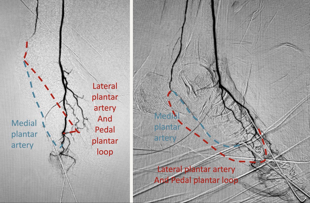 karananandpara's tweet photo. Case 162: with @BhaveshPopat7 @DrAntariksh @shubhamvanshi07 @DrVaibhavThakur
.
Revascularizing both Below the Ankle (BTA) Pedal Vascular Loops
.
YouTube Link: https://t.co/JpozoUoDqw
.
#irad #virad #endovascular #meded #medx #medtwitter #cardiotwitter @SIRspecialists @SIR_ECS https://t.co/497wlBlZ02