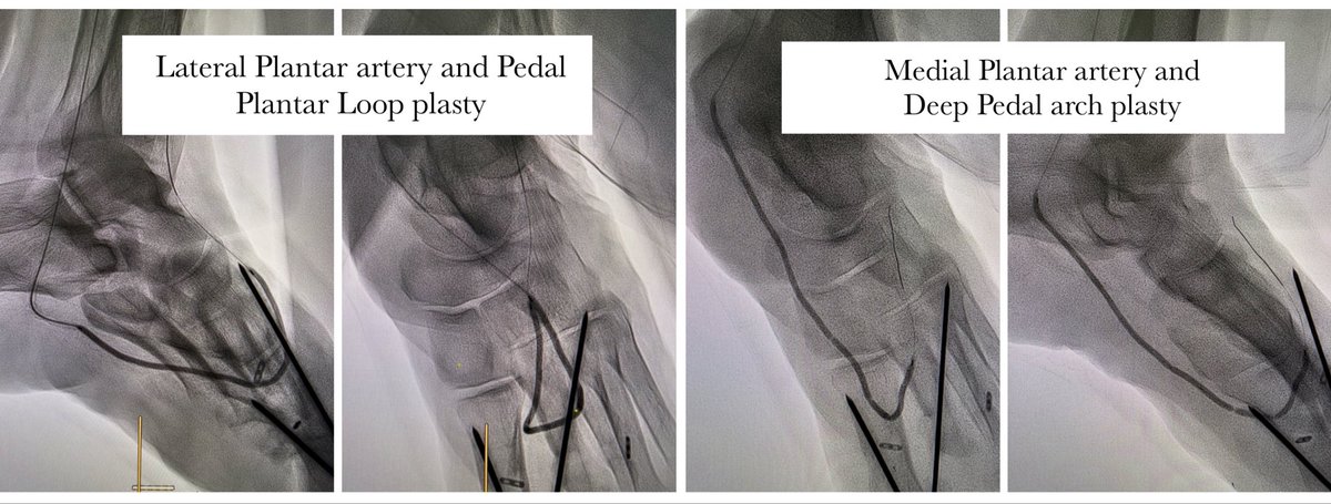 karananandpara's tweet photo. Case 162: with @BhaveshPopat7 @DrAntariksh @shubhamvanshi07 @DrVaibhavThakur
.
Revascularizing both Below the Ankle (BTA) Pedal Vascular Loops
.
YouTube Link: https://t.co/JpozoUoDqw
.
#irad #virad #endovascular #meded #medx #medtwitter #cardiotwitter @SIRspecialists @SIR_ECS https://t.co/497wlBlZ02
