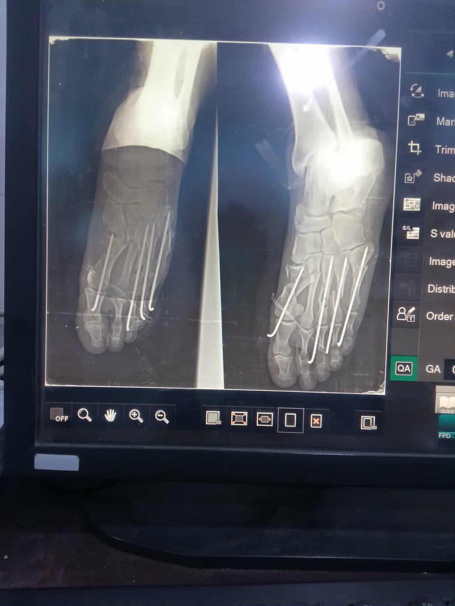 NihadformGaza's tweet photo. My husband went to collect food aid to feed his family during the famine, but he was shot in the leg, leaving him disabled. Our family is now in dire need of support to provide food, clothing, basic necessities, and daily medical treatment. https://t.co/all1SLvqzh