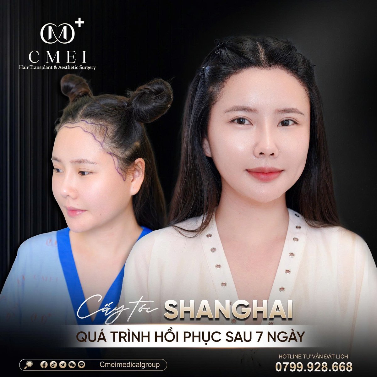 cmeimedical's tweet photo. CMEI International Clinic - Hair Transplant Vietnam &amp; Aesthetic Surgery

📍 24–26 Pham Ngoc Thach St., Xuan Hoa Ward, District 3, Ho Chi Minh City, Vietnam
 📞 Hotline | Wsapp | Zalo (+84) 799 928 668
📮 Wechat : Cmeimedicalgroup
📮Line : Cmeimedicalgroup
 https://t.co/1A0gU3oVfr https://t.co/vw09SZp5GL