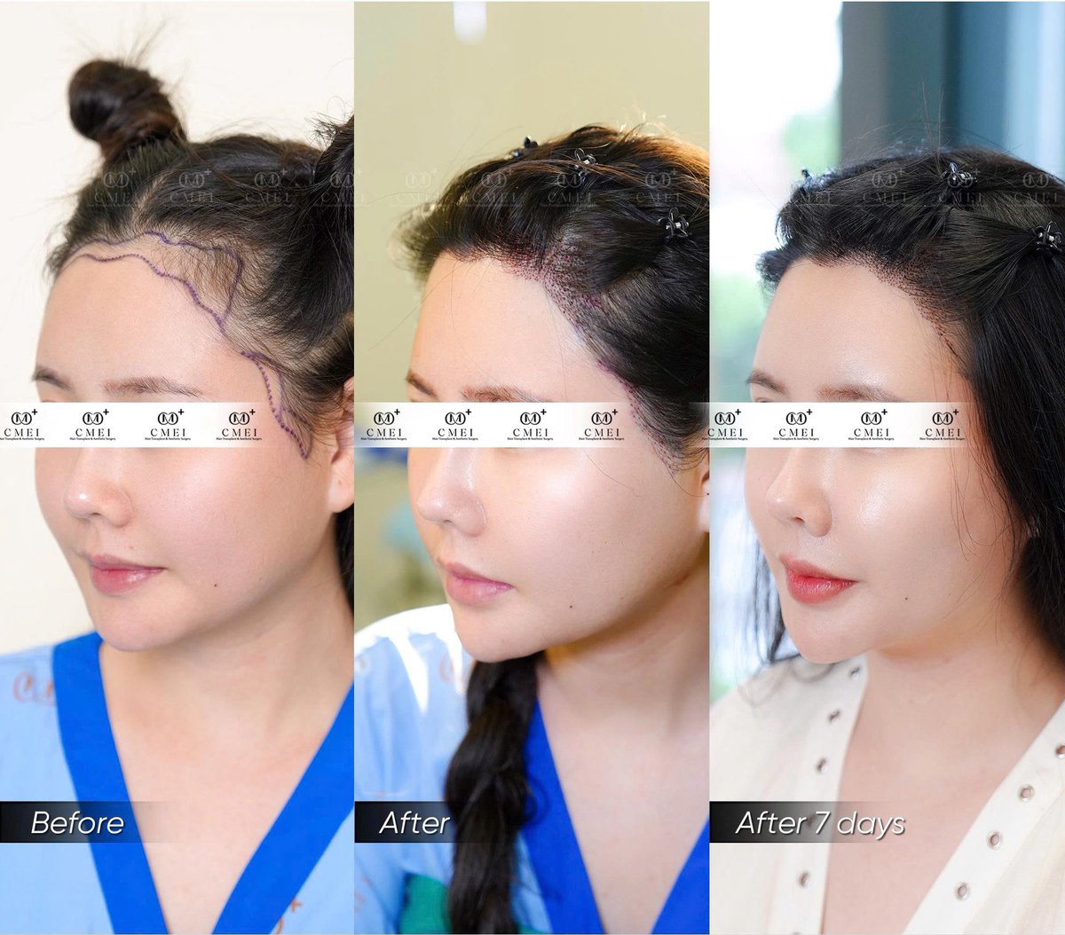 cmeimedical's tweet photo. CMEI International Clinic - Hair Transplant Vietnam &amp; Aesthetic Surgery

📍 24–26 Pham Ngoc Thach St., Xuan Hoa Ward, District 3, Ho Chi Minh City, Vietnam
 📞 Hotline | Wsapp | Zalo (+84) 799 928 668
📮 Wechat : Cmeimedicalgroup
📮Line : Cmeimedicalgroup
 https://t.co/1A0gU3oVfr https://t.co/vw09SZp5GL