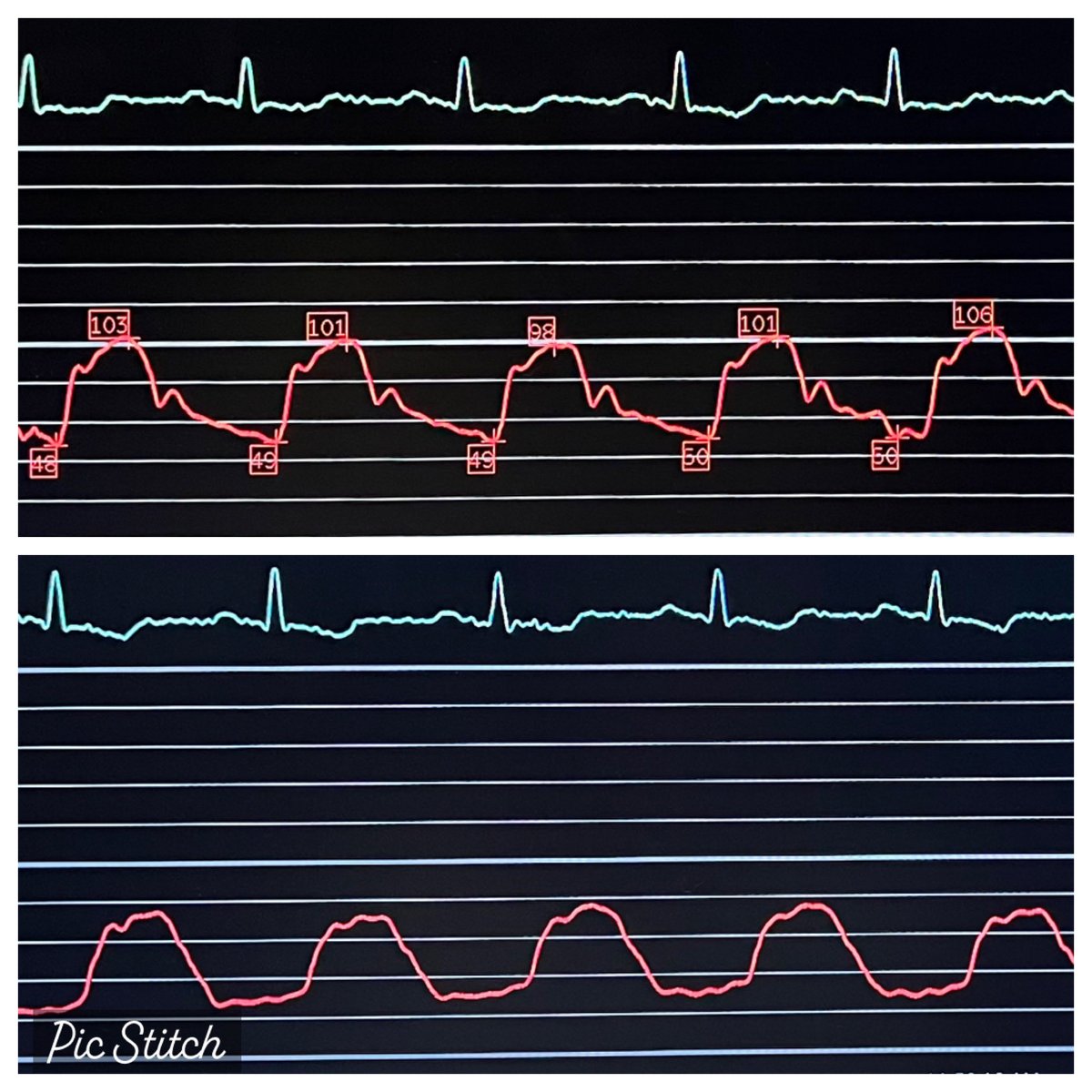 realarainmd's tweet photo. The Left Main Blues

The right side’s no good,
The side holes don’t work,
And the IVUS won’t pass…
I’ve got them Left Main Blues

79 M with CCS 3 angina on OMT, EF 50%, cancer survivor, non-diabetic. What would you do?

BTW, the surgeon is not on vacation, and no one in the lab has heard of CHIP-BCIS3. 😂