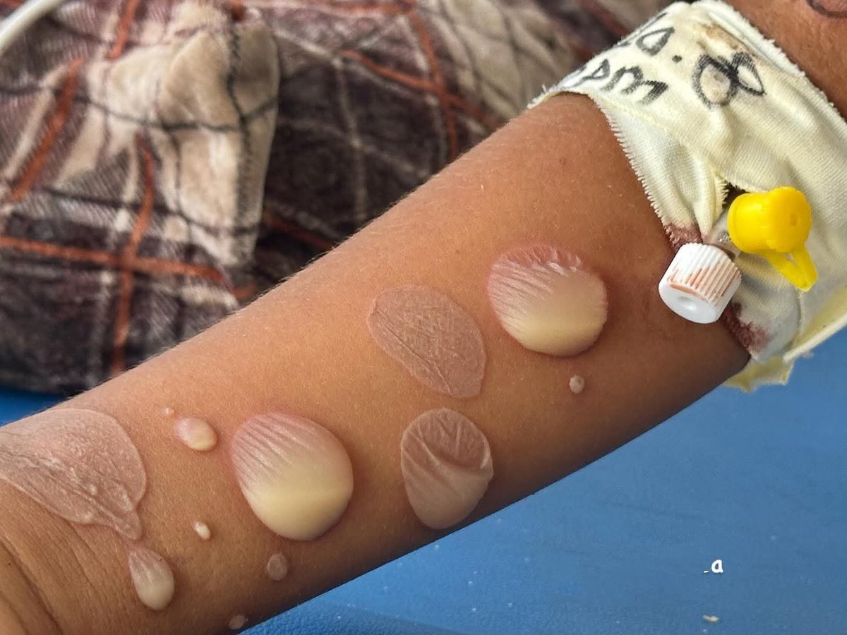 yousefQasem1998's tweet photo. Scabies has spread all over my child's body I am worried about my baby girl 😥😭

 Donate even $10

https://t.co/45Gj0rpJam https://t.co/jtPEuw0Qh2