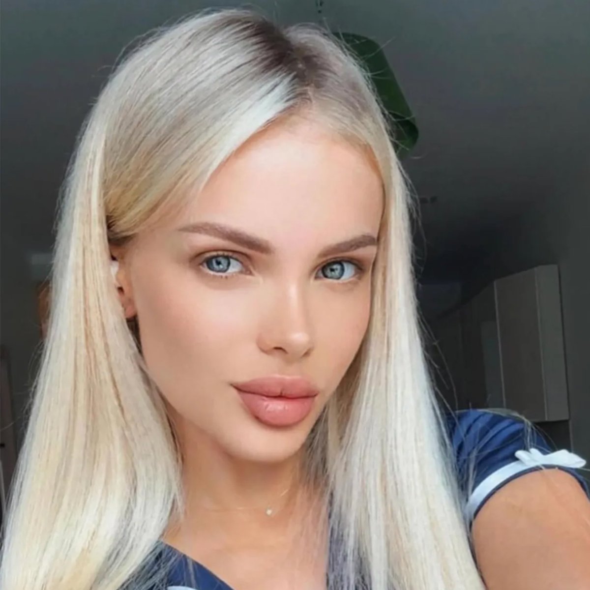 creepydotorg's tweet photo. Angelika Tartanova, a 33-year-old Russian model, lost nearly half her skull after being severely beaten by her boyfriend, wealthy construction businessman Dmitry Kuzmin.

The attack left her with severe brain damage. She was unable to speak for months and required several operations and extensive rehabilitation.

Kuzmin was later charged with attempted murder and faced up to eight years in a Russian prison or being sent to fight in Ukraine.

But before he could stand trial, he suddenly died of a heart attack while under house arrest. Angelika survived and continues to recover.