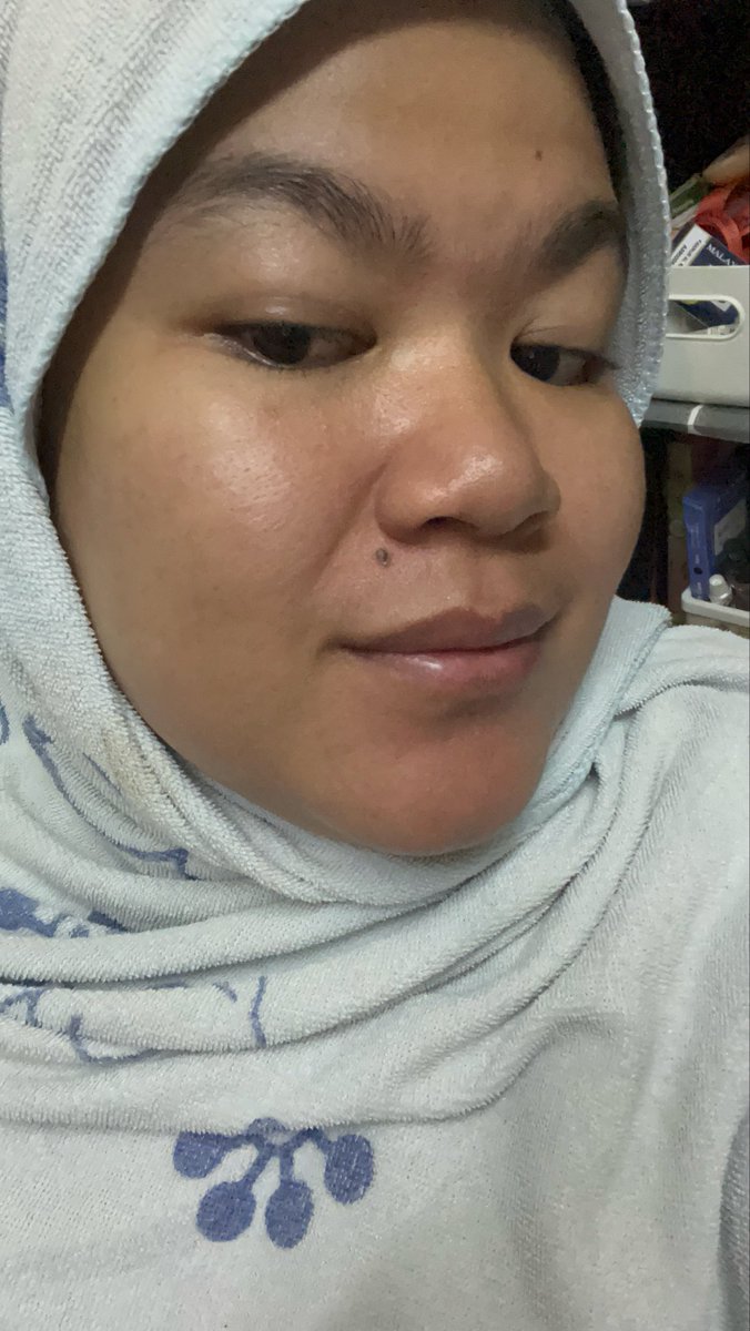 manisnabilah's tweet photo. Penat taw nak bebas acne ni. Finally ❤️ https://t.co/gYpX0Ml2ai