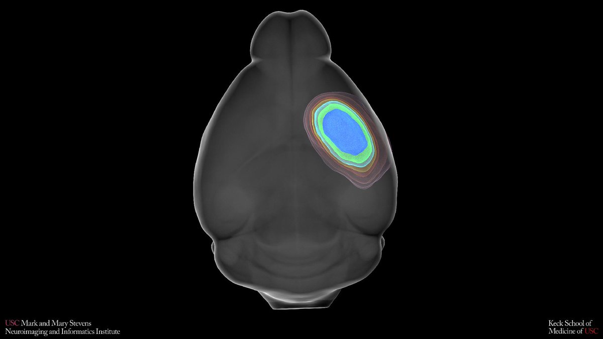KECKSchool_USC's tweet photo. .@USCLONI researchers at the Keck School of Medicine of USC built an open-source MRI pipeline that standardizes stroke injury measurement across 6 labs, matching human expert analysis. https://t.co/nCepXrDRB0

Photo/Stevens INI https://t.co/jnA1Yoh6DI