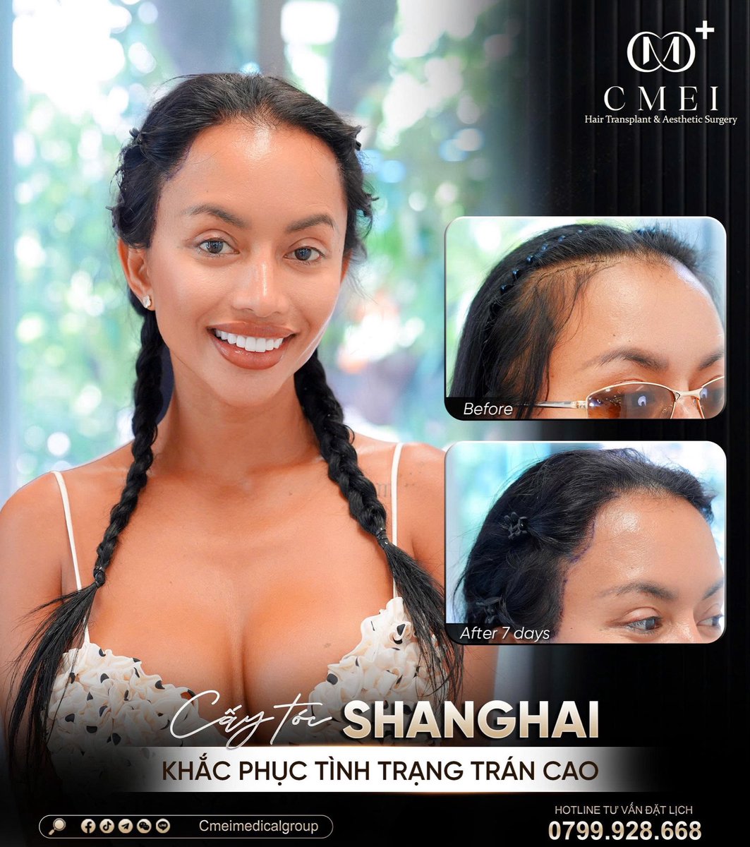 cmeimedical's tweet photo. CMEI Hair Transplant Vietnam
📍 24–26 Pham Ngoc Thach St., Xuan Hoa Ward, District 3, Ho Chi Minh City, Vietnam
 📞 Hotline | Wsapp | Zalo (+84) 799 928 668
📮 Wechat : Cmeimedicalgroup
📮 Line : Cmeimedicalgroup
🏥Website : https://t.co/1A0gU3oVfr
#hairtransplantvietnam https://t.co/S74lVoWp7B